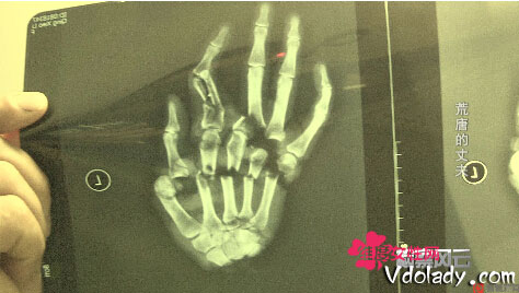 四川偏执男剁妻子左手 只为防妻出轨使之成残疾人