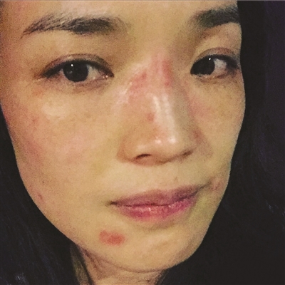 舒淇的脸被桃花癣毁了 快帮皮肤逃过桃花劫