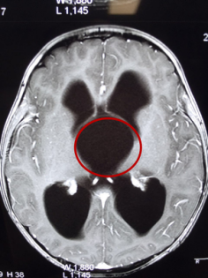 突破!上海蓝十字脑科医院开展脑室镜蛛网膜囊