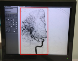 字脑科医院李振并主任超选择性全脑血管造影术